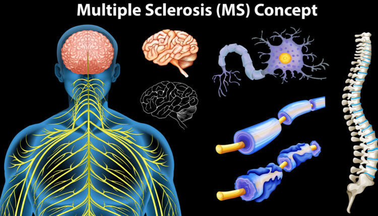 Multiple-Sclerosis.jpg